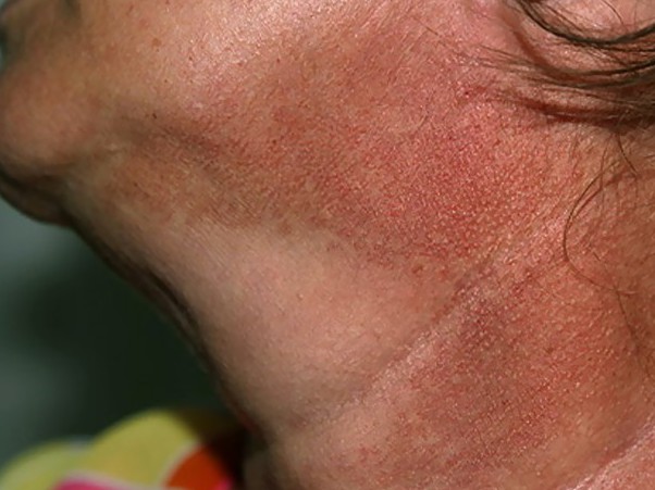 Improve neck discolouration – Lasermed – Laser Hair ...